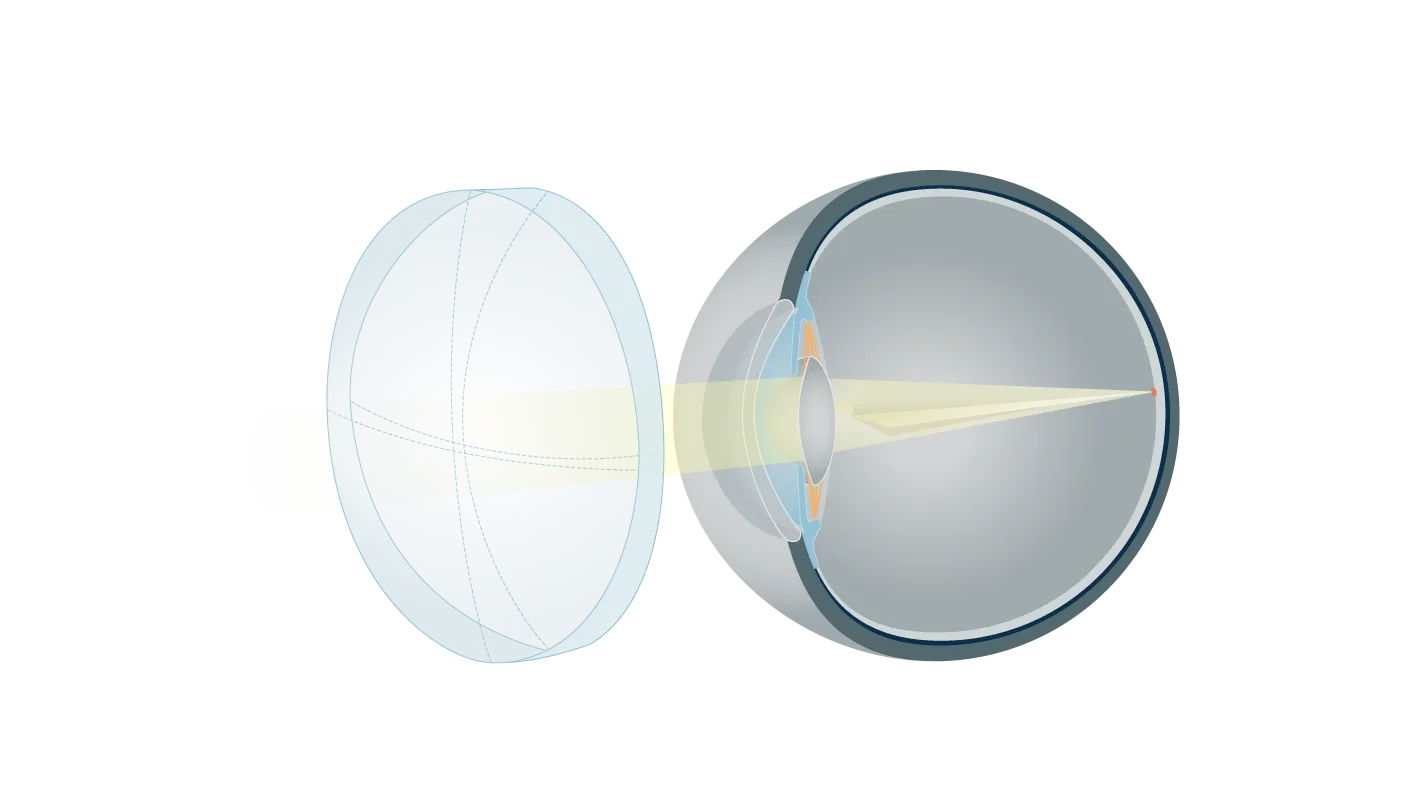 Hoornvliesvervorming (astigmatisme) met torische brillenglazen